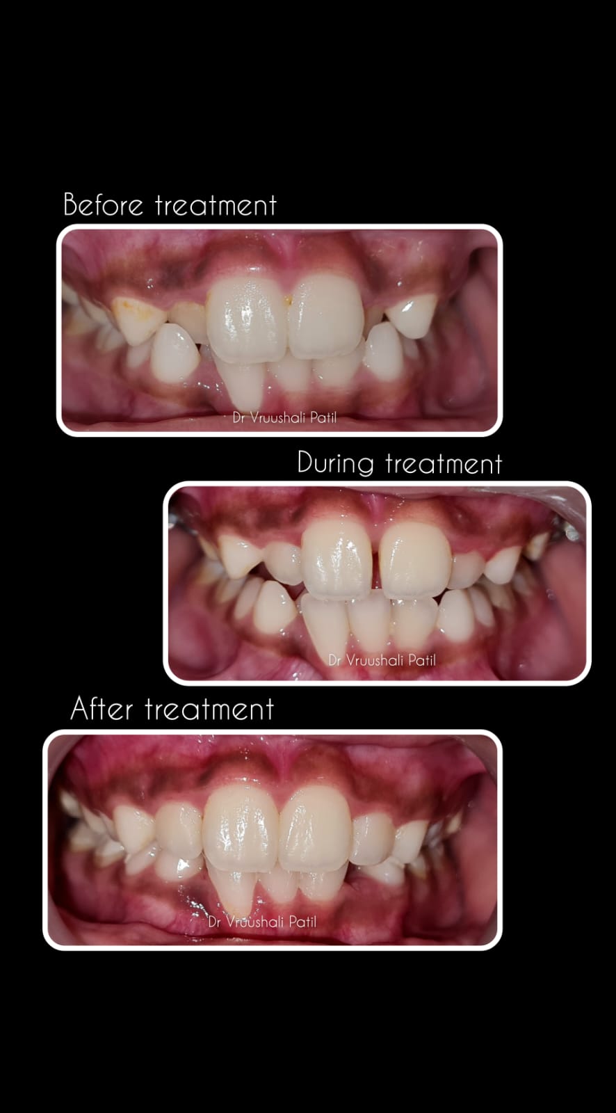 Before, during and after orthodontic treatment at MediVista Dental, Nashik