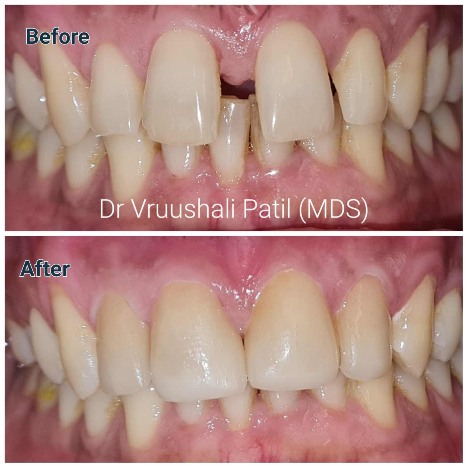 Before and after dental restoration at MediVista Dental, Nashik