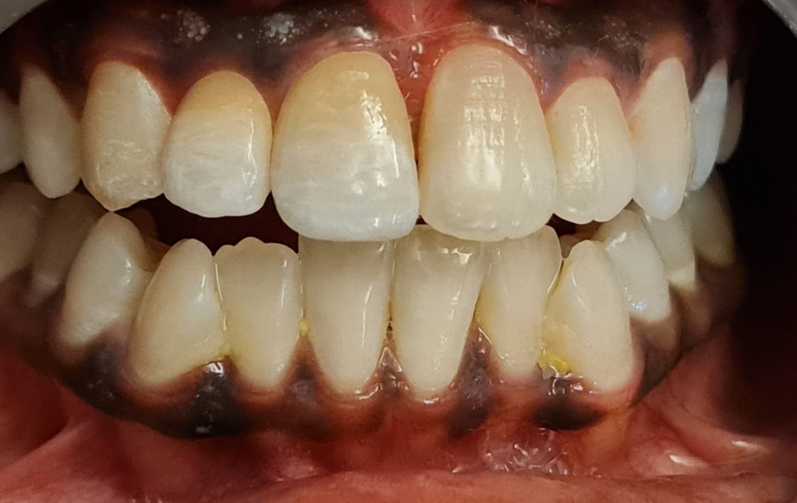 After full implant-supported teeth at MediVista Dental, Nashik
