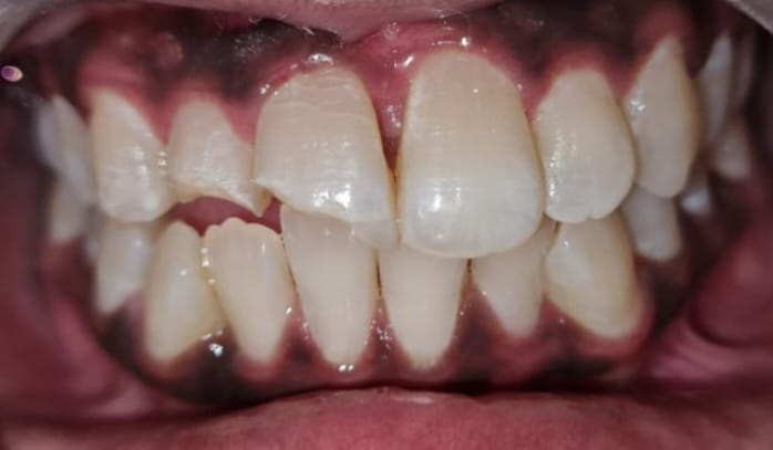 Before full implant-supported teeth at MediVista Dental, Nashik