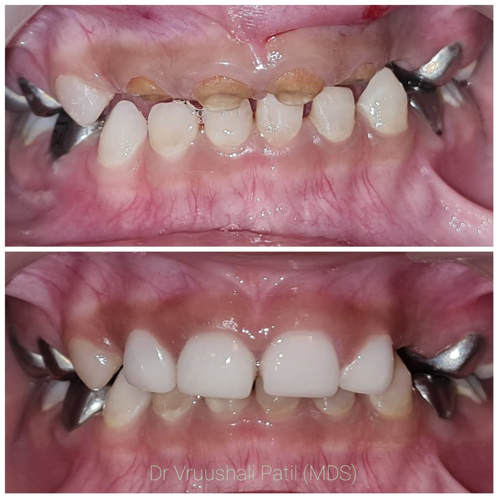 Before and after crown restoration of worn teeth at MediVista Dental, Nashik
