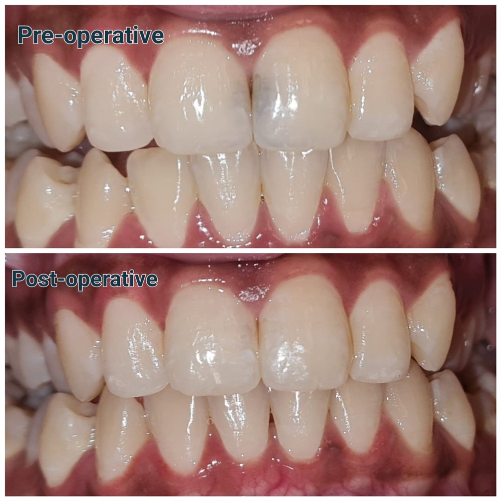 Pre-operative and post-operative discoloured tooth correction at MediVista Dental, Nashik