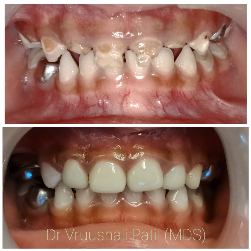 Before and after children's full-mouth dental rehabilitation at MediVista Dental, Nashik