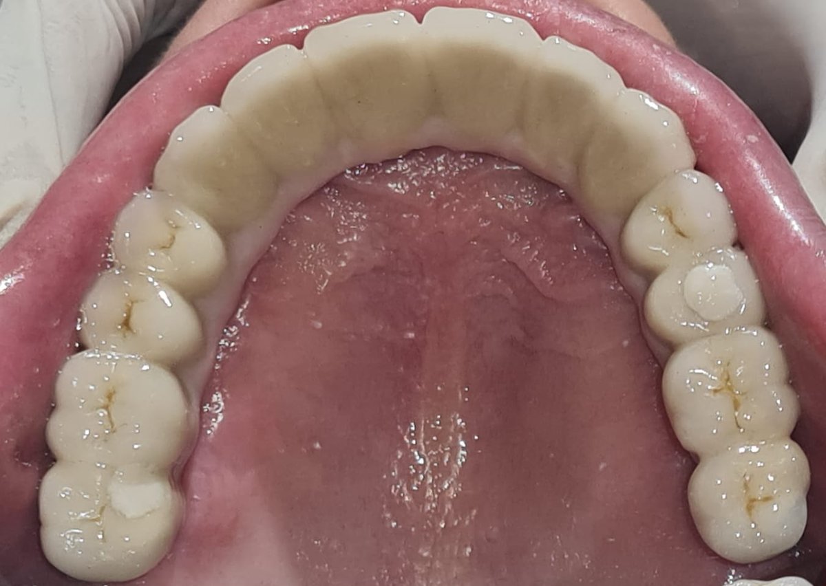 Implant-Supported Teeth — MediVista Dental Clinic, Nashik